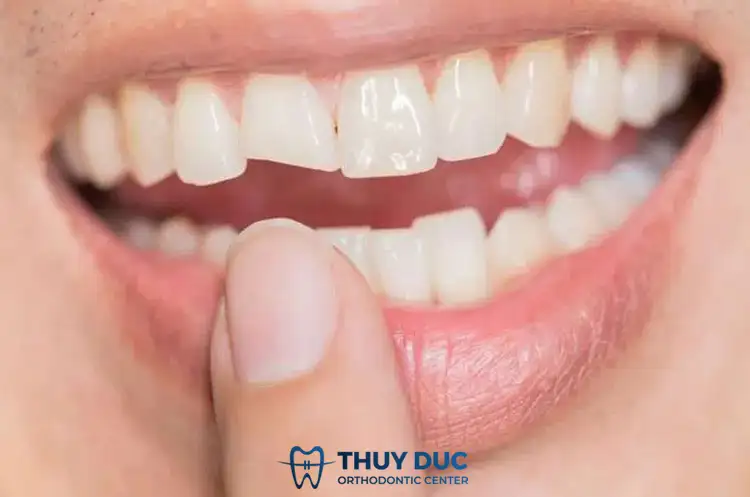 nằm mơ bị gãy răng chảy máu