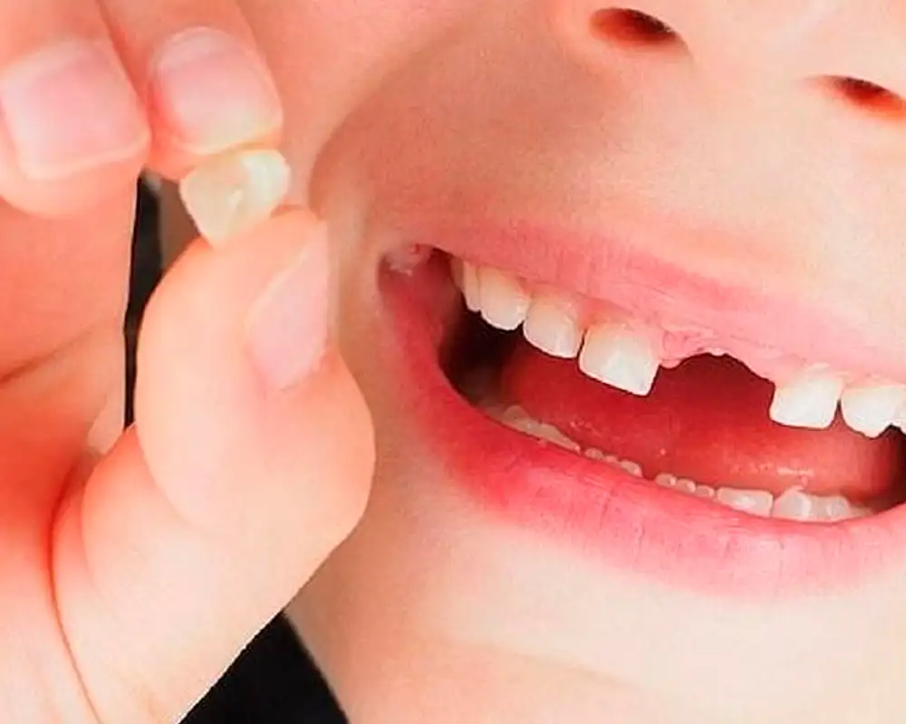 mơ thấy răng cửa rụng