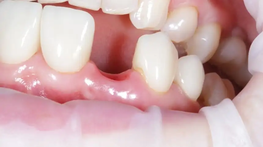 Nằm Mơ Rụng Răng Chảy Máu: Giải Mã Điềm Báo & Ý Nghĩa Sâu Kín Nhất