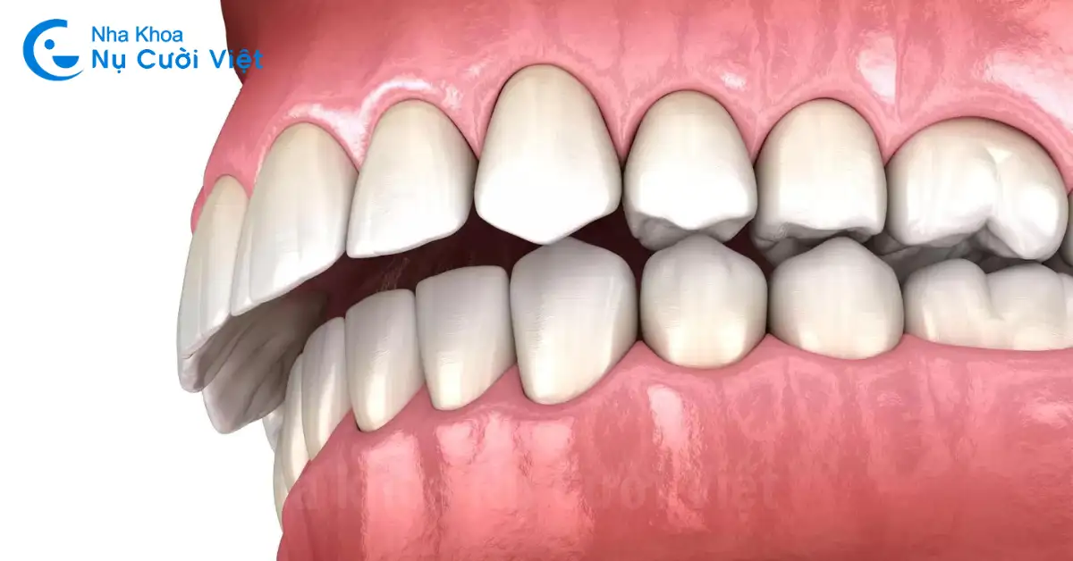 Nằm Mơ Gãy Răng Hàm Dưới: Điềm Báo Tốt Hay Xấu & Giải Mã Chi Tiết Nhất