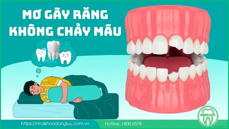 {nằm mơ thấy gãy răng cửa không chảy máu}