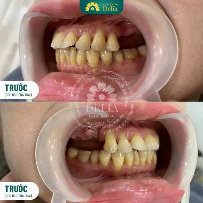 nằm mơ thấy rụng nguyên hàm răng