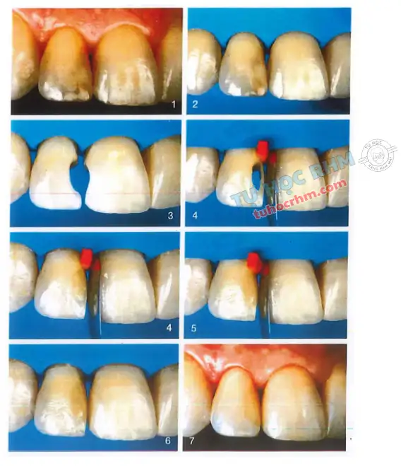 Giải Mã Giấc Mơ Sâu Răng: Điềm Báo Gì, Số May Mắn Nào?