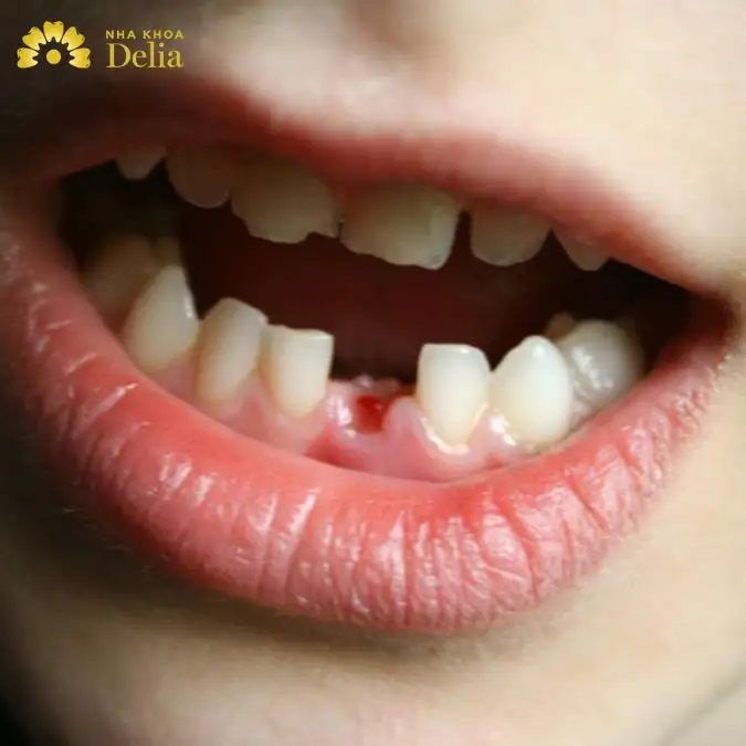 nằm mơ thấy rụng hết 2 hàm răng