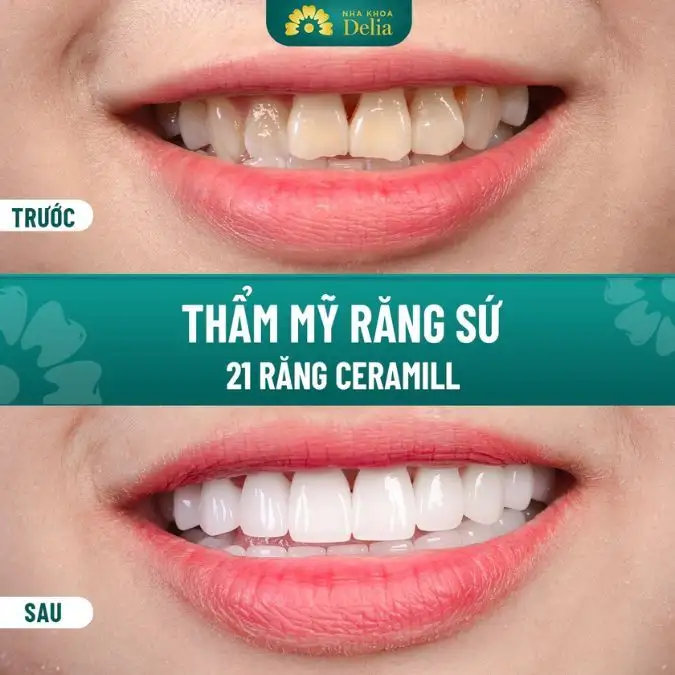 mơ gãy răng không chảy máu