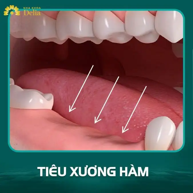 Nằm Mơ Rụng Răng Hàm: Giải Mã Điềm Báo & Ý Nghĩa Sâu Sắc Từ Tâm Linh Đến Khoa Học