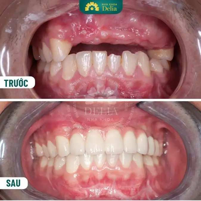 Nằm Mơ Rụng Răng: Giải Mã Điềm Báo Lành Hay Dữ? Ý Nghĩa Tâm Linh & Khoa Học