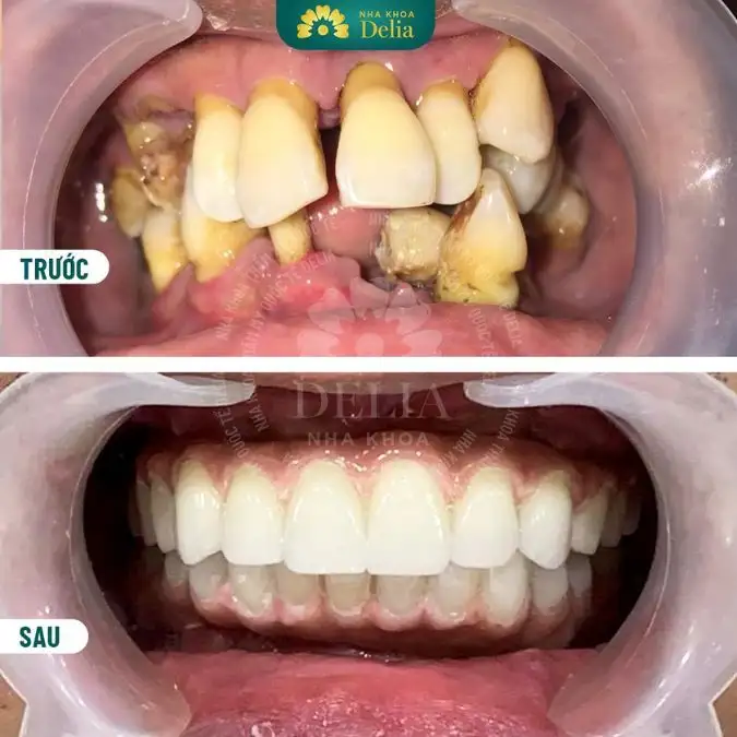 nằm mơ thấy rụng rất nhiều răng không chảy máu