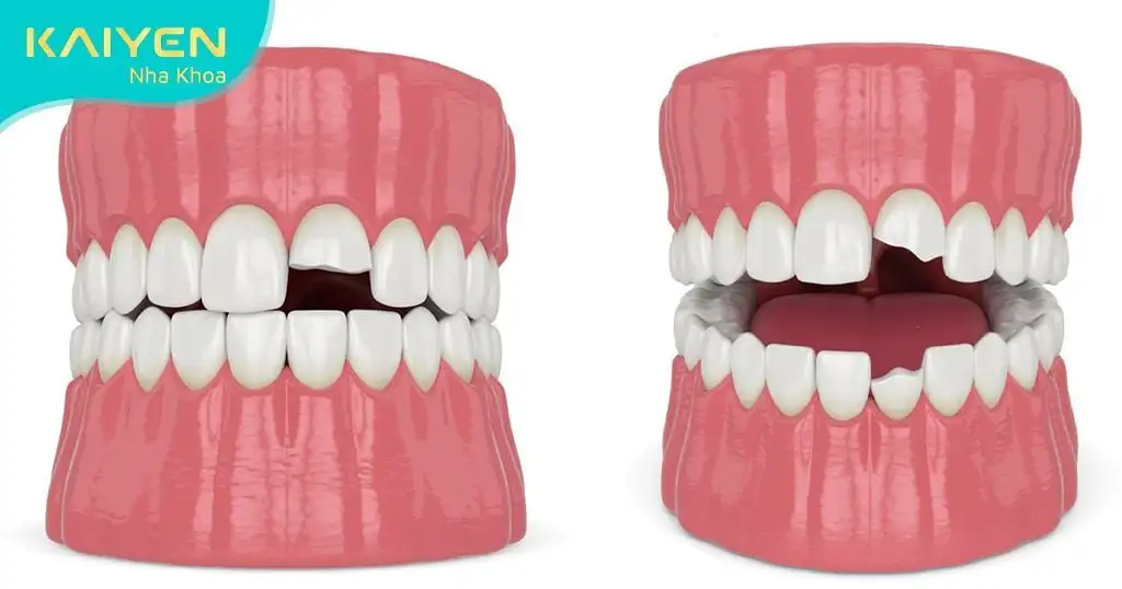 nằm mơ thấy rụng răng đánh số mấy