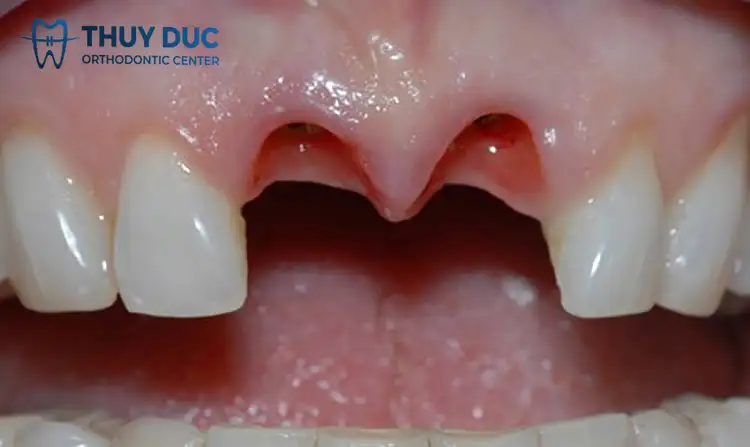 {mơ thấy rụng răng cửa}