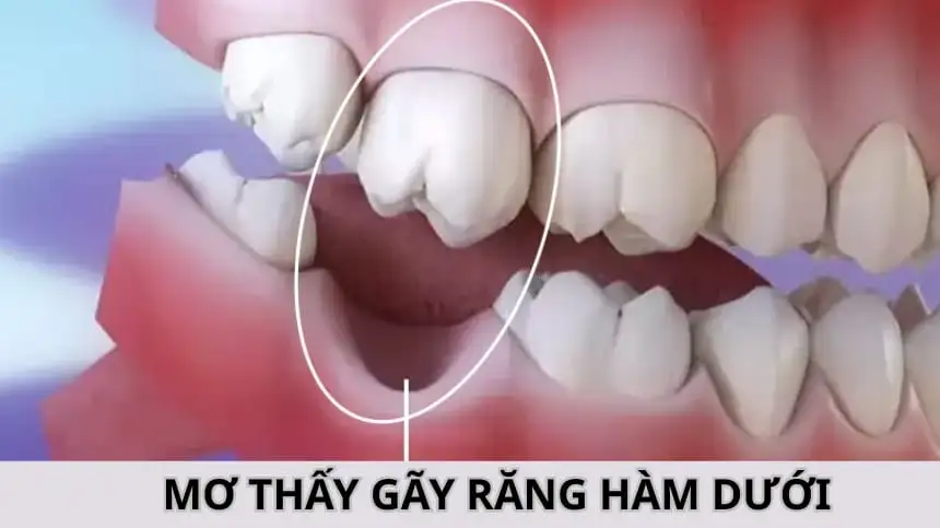 {mơ mình gãy răng}