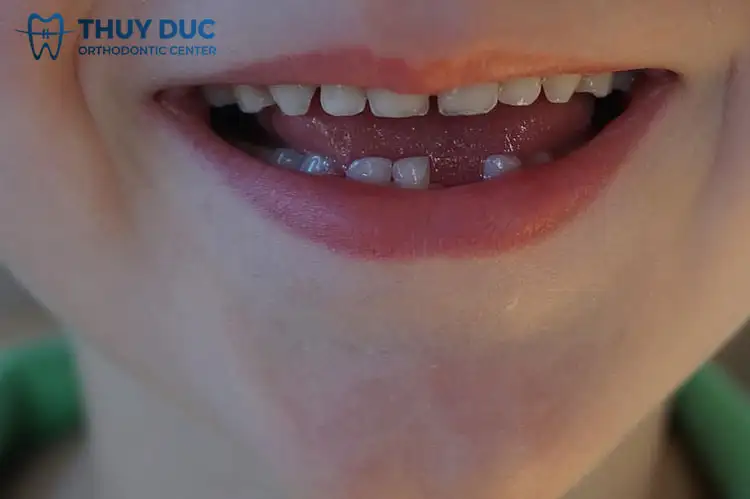 Nằm Mơ Thấy Gãy Răng Chảy Máu Có Sao Không? Giải Mã Điềm Báo Toàn Diện