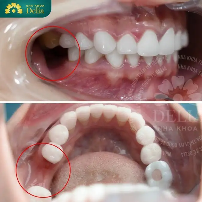 nằm mơ thấy rụng răng dưới